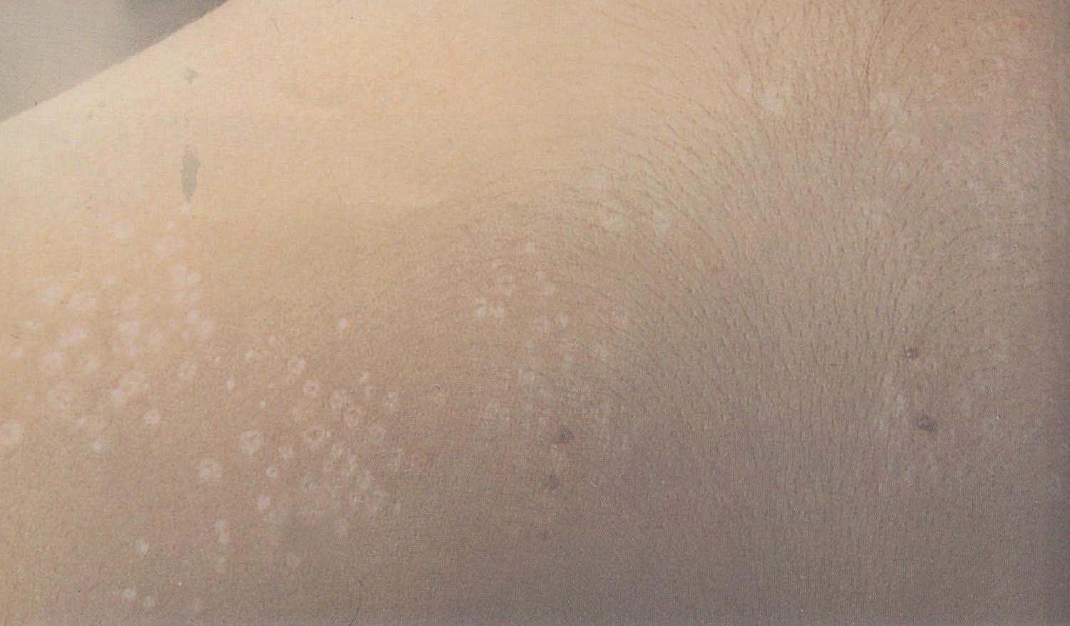 疣状皮肤结核的图片,皮肤结核症状图片_大山谷图库